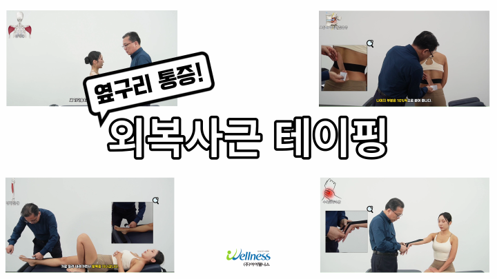 옆구리 통증! 외복사근 테이핑 요법